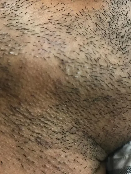 We also treat medical conditions that cause facial hair loss. This is a close up view of Alopecia Areata in the beard area, a condition we regularly diagnose and create personalized treatment plans for at our clinic.