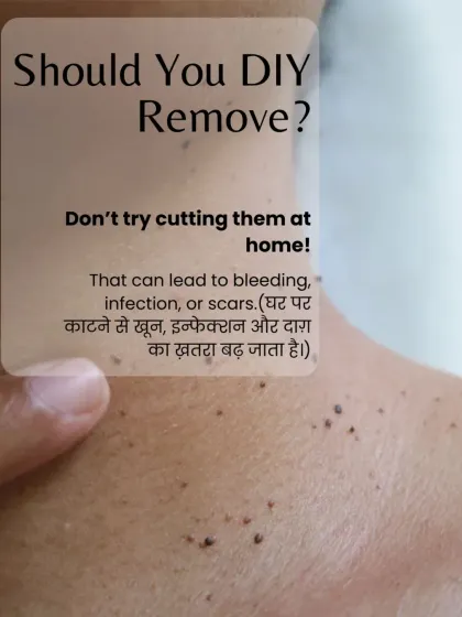 I cannot stress this enough: do not attempt to cut or tie off skin tags at home. The risk of bleeding, infection, and scarring is very high. Professional removal is the only safe option.