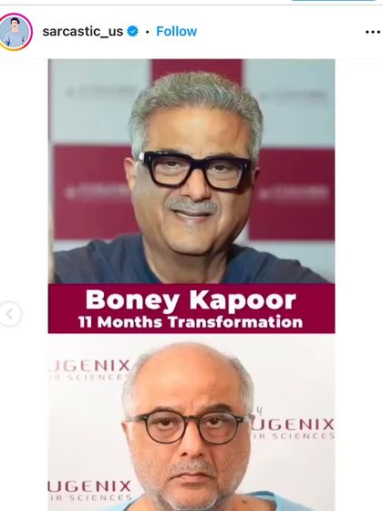 An 11-month transformation of renowned film producer Boney Kapoor. This before-and-after image, featured by Sarcastic Us, showcases the remarkable difference our work has made.