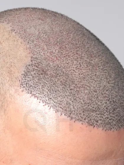 A close-up of graft placement for a Norwood Grade 6 case. 6000 grafts were implanted in a single session for full coverage.