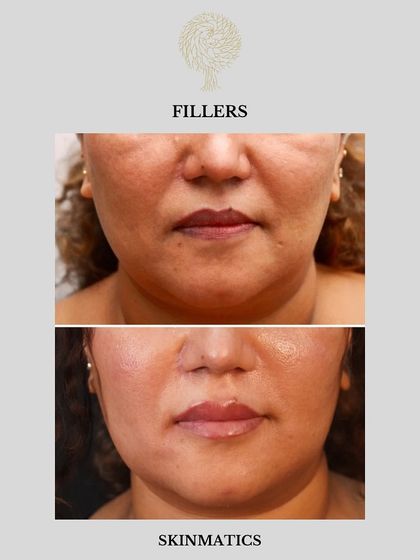 Skinmatics - Facial Aesthetics & Anti-Aging Dermal Fillers: Sculpt & Restore Volume photo 12