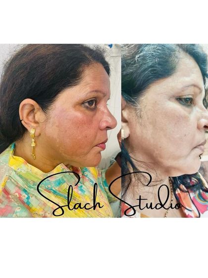 This side-profile before-and-after highlights the treatment's effectiveness in clearing pigmentation and improving overall skin health.