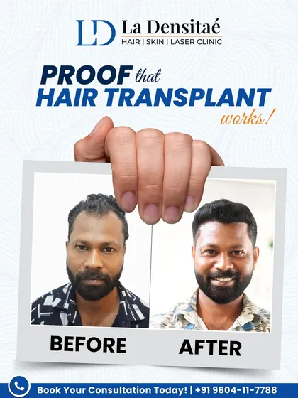 Many people are skeptical about hair transplants until they see the proof. This is Biju, whose transformation speaks for itself. Using your own hair, I restore your natural hairline with results that are designed to last, giving you back not just your hair, but your confidence.