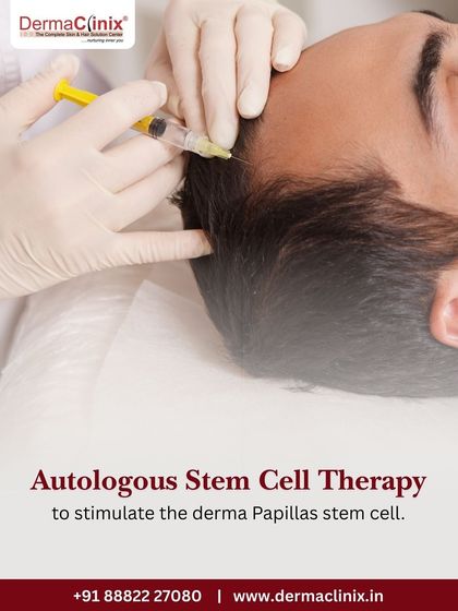 Autologous Stem Cell Therapy is a cornerstone of our regenerative approach. This procedure uses your own stem cells to stimulate the derma papilla stem cells in the scalp, promoting new growth.