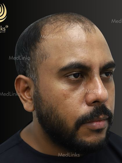 The patient's hair from the side before the procedure, showing significant balding.