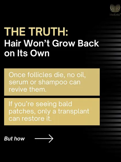 Here is the truth: once hair follicles die, no oil or shampoo can revive them. If you are seeing bald patches, a hair transplant is the only way to restore hair in that area.