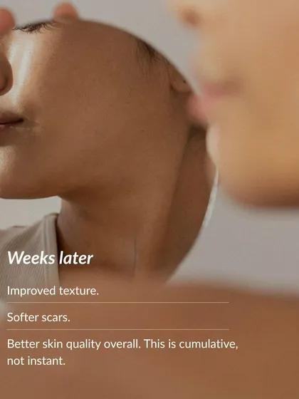 Microneedling results are cumulative, not instant. Weeks after a session, clients notice significant improvements in skin texture, softer scars, and better overall skin quality as collagen rebuilds.