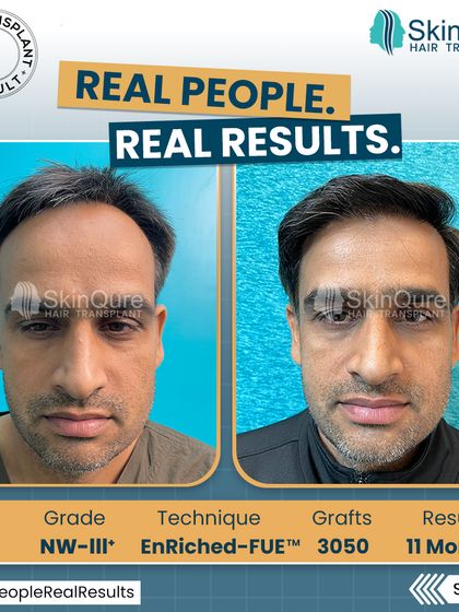 A frontal view of the 39-year-old patient's transformation. The before and after comparison clearly shows the restored hairline and increased density, which has significantly improved his facial framing.