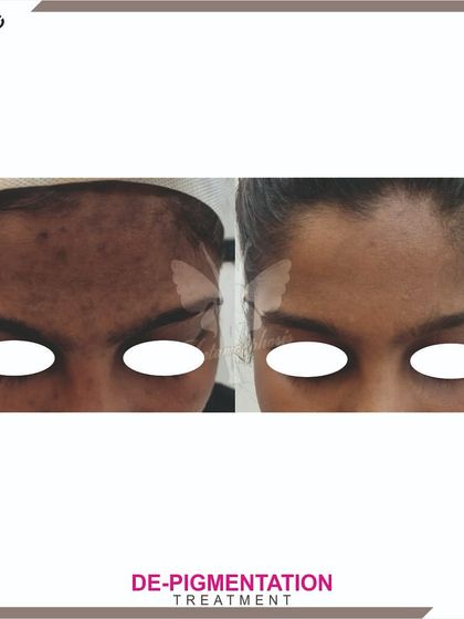 This client's forehead pigmentation was significantly reduced with a custom plan, resulting in a much more even and clear skin surface.