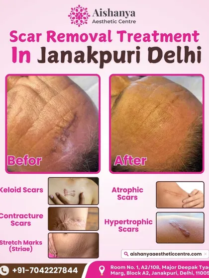 Here is a showcase of various types of scars I treat, from keloids to stretch marks. The main image shows a significant improvement in a surgical scar, demonstrating the effectiveness of our scar removal protocols.