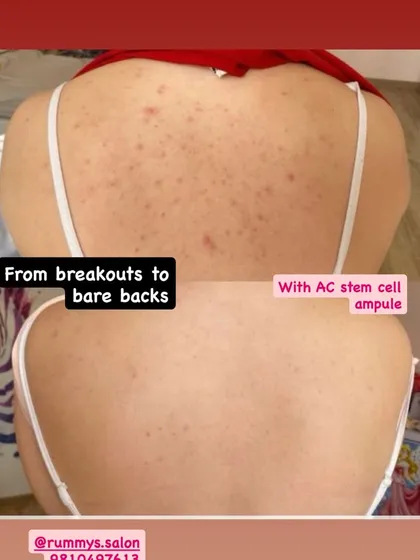 My treatments are not just for the face. This before-and-after demonstrates a dramatic improvement in back breakouts after using a targeted AC Stem Cell ampoule, leading to clearer, smoother skin.