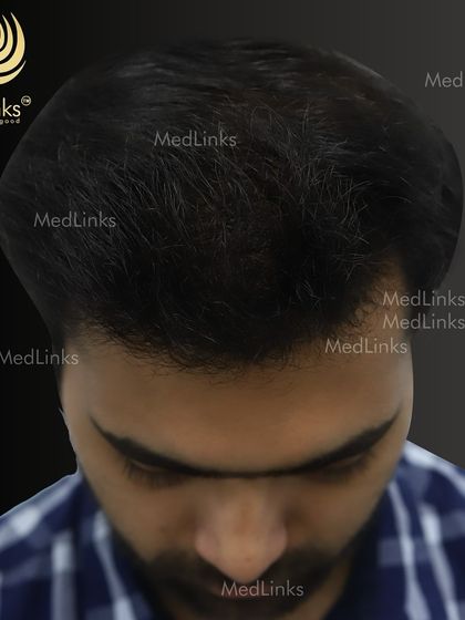 The top-down view after the transplant, showcasing the full coverage achieved.