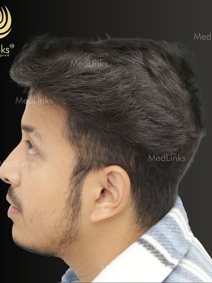 The final result from the side, showing a natural and dense hairline.