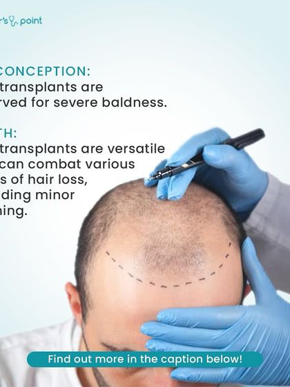 We're debunking a common misconception about hair transplants. This procedure is not just for severe baldness; it's a versatile solution for various levels of hair loss, including minor thinning.