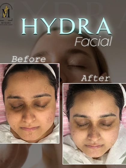 From dull to dazzling, this before and after shot is a testament to the immediate, visible results of our HydraFacial treatment.