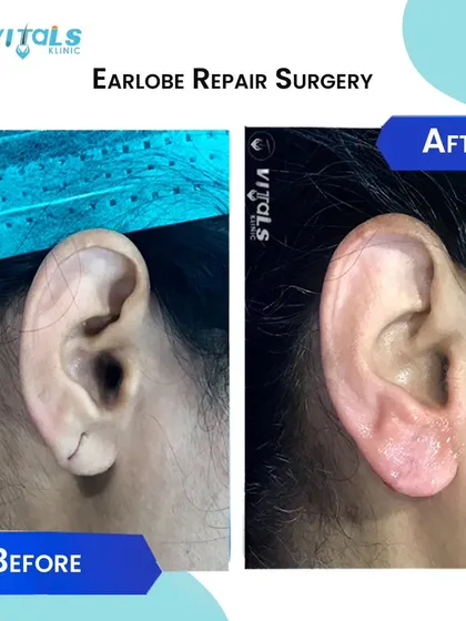 A demonstration of earlobe repair surgery for a torn lobe. Using fine surgical techniques, I meticulously reconstruct the tissue to restore its original appearance, allowing patients to wear earrings again with confidence.