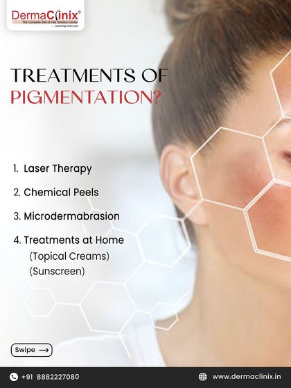 An infographic listing the different treatments we offer for pigmentation. Our comprehensive approach includes laser therapy, chemical peels, microdermabrasion, and topical creams.