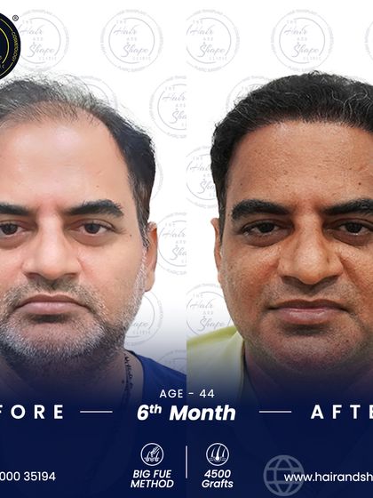 The frontal view at 6 months. The BIG FUE method has effectively restored his hair, giving him a much more youthful appearance.