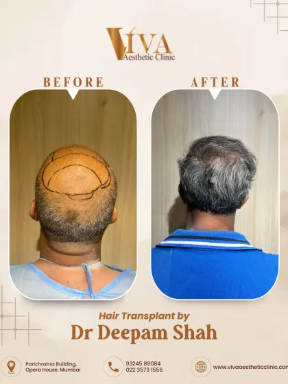 The crown restoration for the same patient. Recreating the natural whorl pattern of the crown is crucial for a result that looks authentic, even from behind.