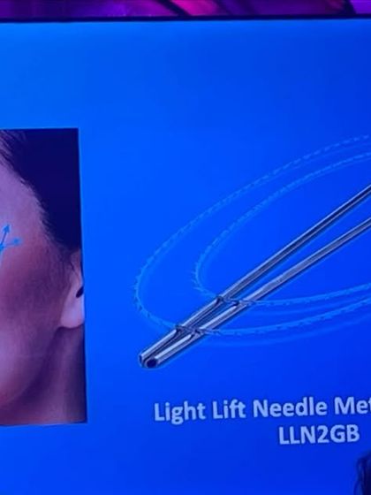 This diagram illustrates the Light Lift Needle Method used in Aptos thread lifts. This technique allows for precise placement of threads to achieve a natural-looking lift for the cheeks and eyebrows.