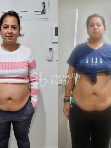 The before and after photo of the client who focused on inch loss. Her transformation shows that the scale doesn't always tell the whole story of your progress.