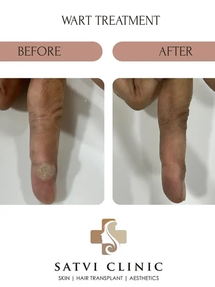 Here is a successful wart removal on a finger using intralesional immunotherapy. This non-surgical wart treatment works by activating the body's own immune system to fight the virus, avoiding cuts or burns and reducing the chance of scarring.