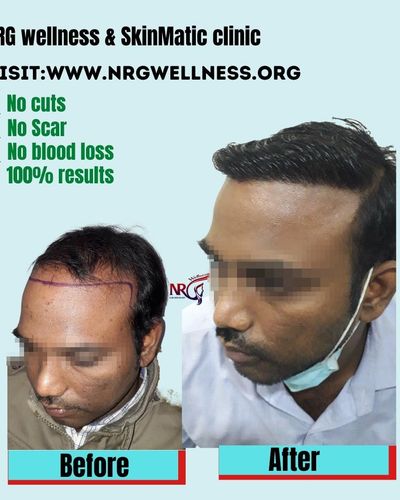 Non-Surgical Hair Loss Treatments