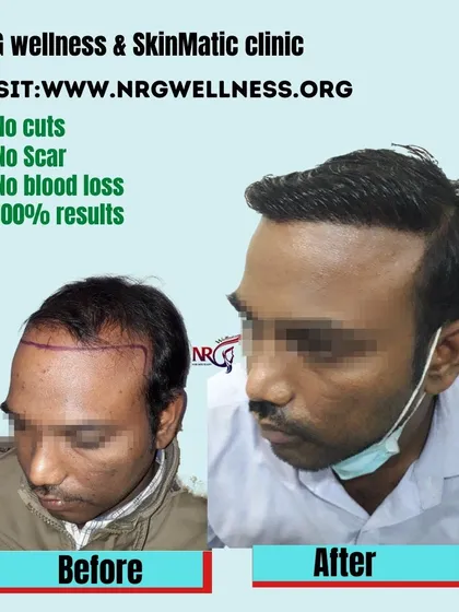 Our FUE hair transplant procedure is designed for your comfort and to deliver the best outcome. We promise a process with no cuts, no linear scars, and minimal blood loss, leading to 100% natural results.