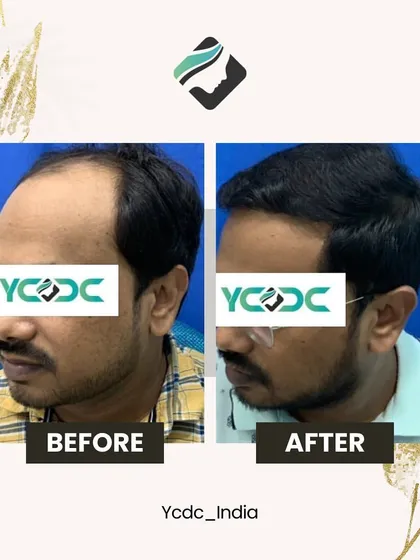 A side-view comparison of a hair transplant result. Notice the restored hairline and increased thickness, which frames the face and creates a more youthful appearance.