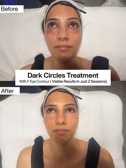 Here you can see the visible results of my targeted Dark Circles Treatment after just two sessions. I use a specialized F-Eye Contour serum to reduce puffiness and lighten pigmentation for a brighter, more rested appearance.