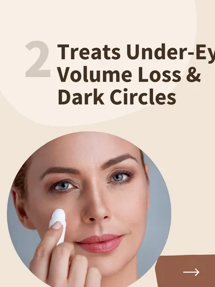 Benefit 2 of PlasmoDerm: It's an excellent treatment for under-eye volume loss and dark circles.