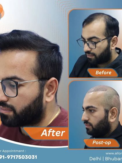 This series shows the full journey: the 'before' state with significant hair loss, the 'post-op' view with freshly implanted grafts, and the final 'after' result with a full, natural head of hair.