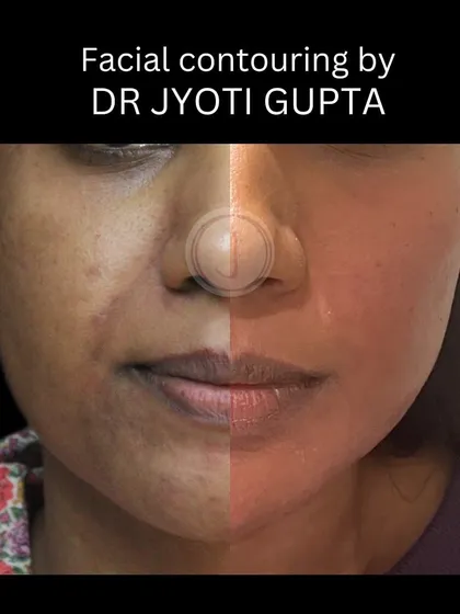 A split-face view demonstrating the power of facial contouring. The right side shows the immediate post-procedure result, with enhanced volume and a smoother contour compared to the untreated left side.