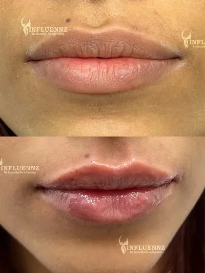 This is a great example of how lip fillers can enhance your natural beauty. We added subtle volume and definition to create a balanced, hydrated, and youthful pout. The goal is always to refine, not to change your look entirely.