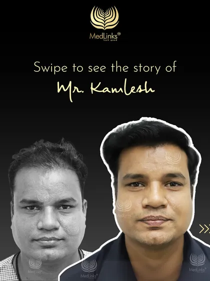 This collage tells the story of Mr. Kamlesh, a 40-year-old gentleman who came to us with lost confidence due to hair loss.