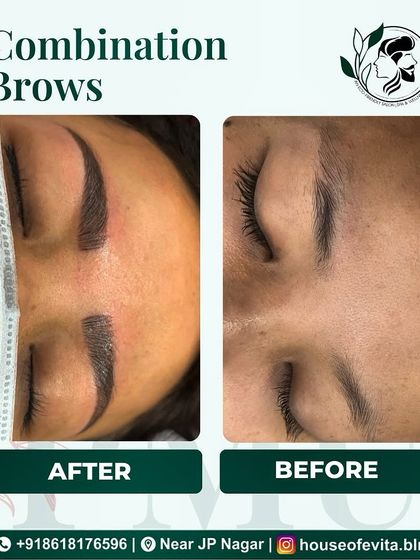 This before-and-after shows how Combination Brows can create structure and fullness. The mix of microblading and shading gives a polished look that still appears natural.