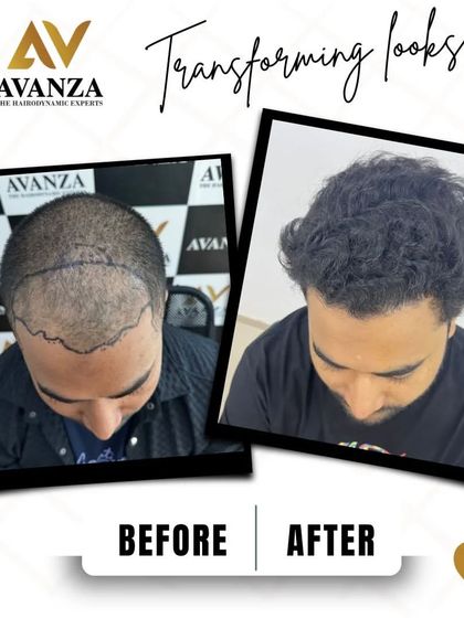 This image shows the pre-operative hairline design and the final, dense result. We created a natural, slightly receded hairline appropriate for his age, which is key to a believable outcome.