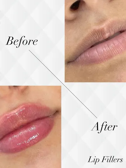 Here is a beautiful example of my lip filler work. I focus on enhancing the natural shape and restoring volume for a hydrated, balanced look, avoiding the overfilled or "duck" look.