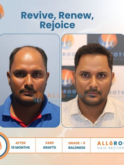 Revive, Renew, Rejoice. This 10-month result for a Grade 5 baldness case, using 3480 grafts, shows a complete restoration. The images from all angles prove that a full head of hair is an achievable goal.