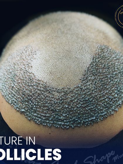 This image highlights the coverage achieved in a single session. We focus on creating a dense pack of follicles that will grow into a strong, healthy head of hair, permanently solving issues of balding or thinning in the transplant area.