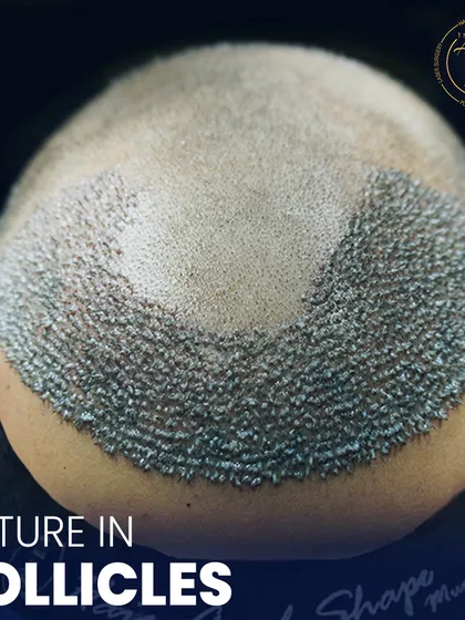 This image highlights the coverage achieved in a single session. We focus on creating a dense pack of follicles that will grow into a strong, healthy head of hair, permanently solving issues of balding or thinning in the transplant area.