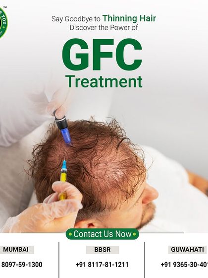 If you are dealing with thinning hair, GFC treatment is a powerful solution. This image captures the moment of treatment, where we use a fine needle to deliver the growth factors that will help you say goodbye to thinning hair.