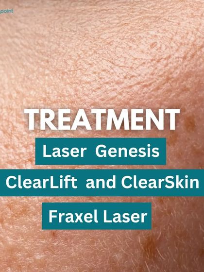 We offer several effective treatments for enlarged pores, including Laser Genesis, ClearLift, and Fraxel Laser. These technologies help to tighten the skin and reduce pore size.