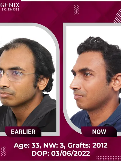 A 33-year-old's successful restoration from Grade 3 baldness with 2012 grafts.