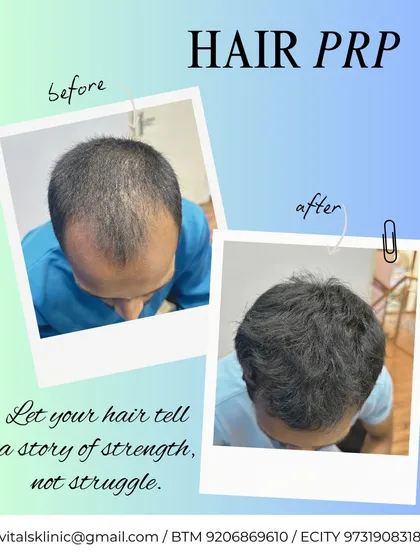 This before and after image shows the significant improvement in hair density following a course of Platelet-Rich Plasma (PRP) therapy. This non-surgical treatment uses the healing power of your own blood to reactivate dormant hair follicles, making it an effective solution for early-stage hair thinning and androgenetic alopecia.