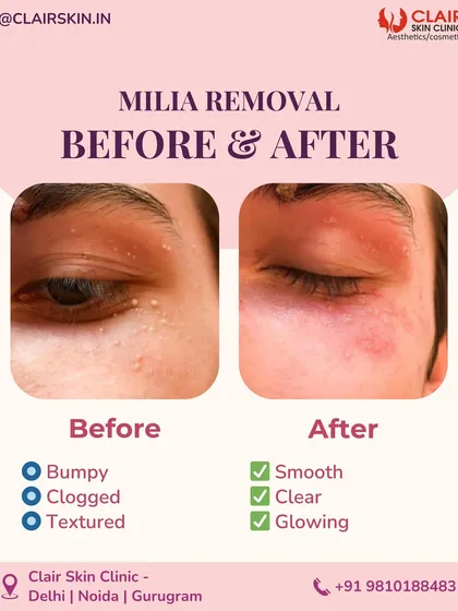 From bumpy and clogged to smooth and clear. This before and after highlights the effectiveness of our milia removal treatment. We safely extract these small cysts to reveal a glowing, even-textured skin surface.