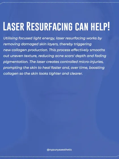 Laser resurfacing works by using focused light energy to remove damaged skin layers, which in turn triggers new collagen production. This process effectively smooths uneven texture, reduces the depth of acne scars, and fades pigmentation for tighter, clearer skin.