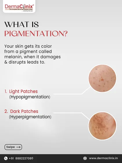 This graphic explains what pigmentation is, detailing how damaged melanin can lead to light patches (hypopigmentation) or dark patches (hyperpigmentation).