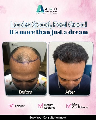 Hair Transplant