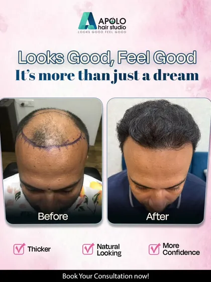 This is the result we strive for with every hair transplant. The goal is not just to add hair, but to restore a natural, thicker hairline that boosts your confidence and makes you feel good.